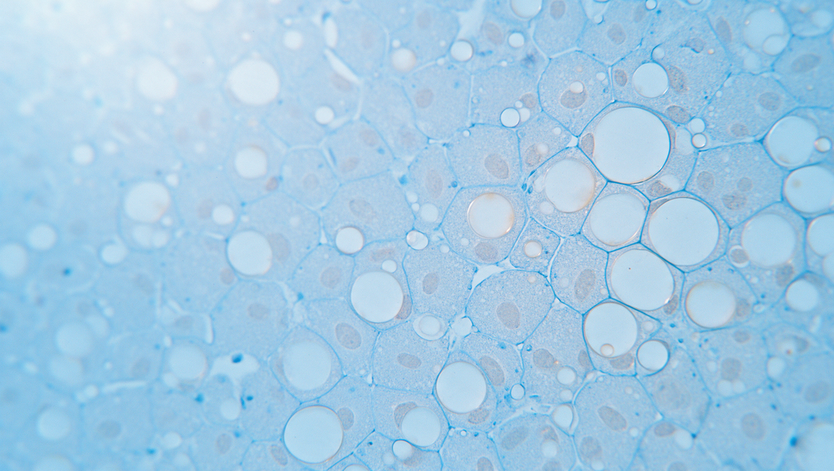 Coupe de tissu hépatique au microscope, cellules du foie remplies de gouttelettes de graisse rondes, teintes bleu ciel