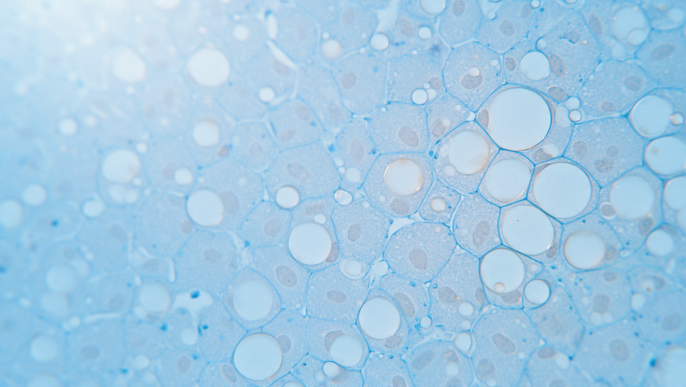 Coupe de tissu hépatique au microscope, cellules du foie remplies de gouttelettes de graisse rondes, teintes bleu ciel